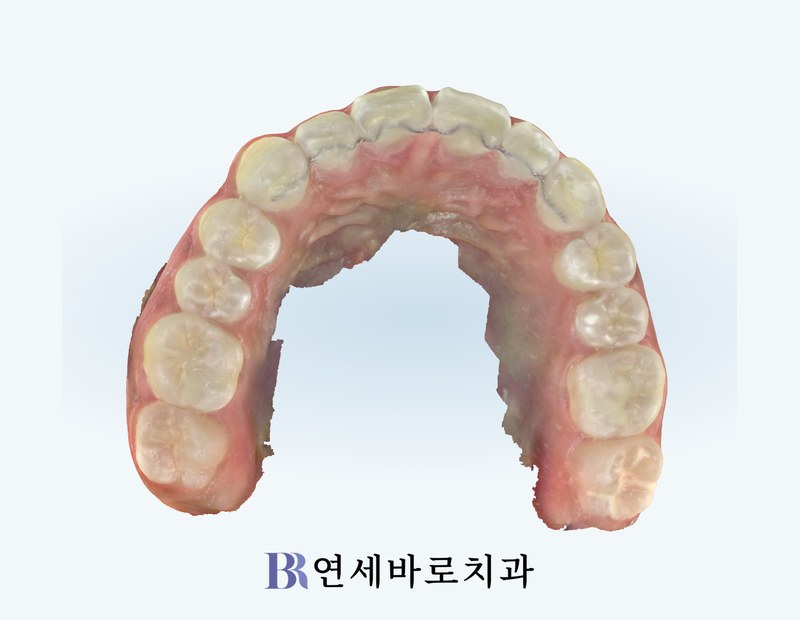 치료 후 상악
