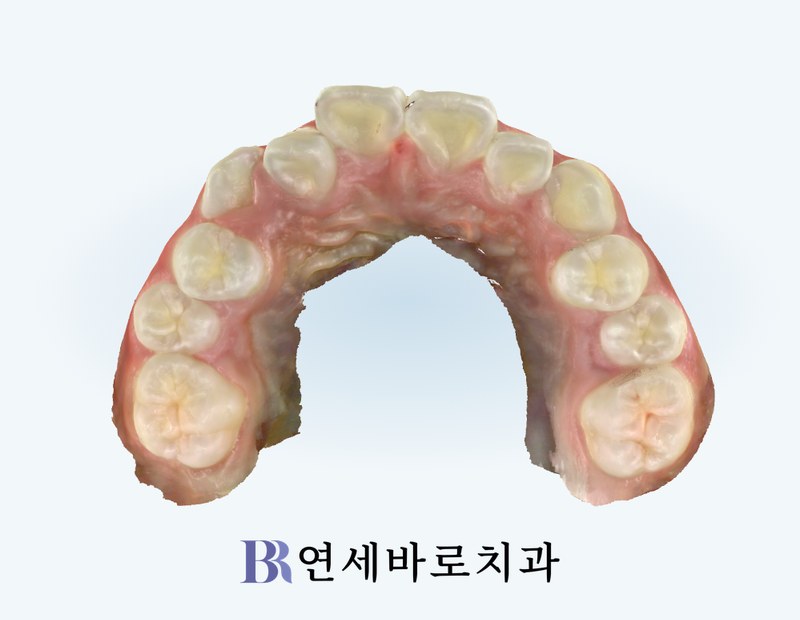 치료 전 상악