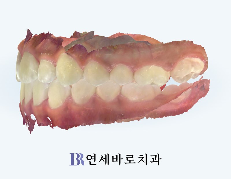 치료 후 좌측