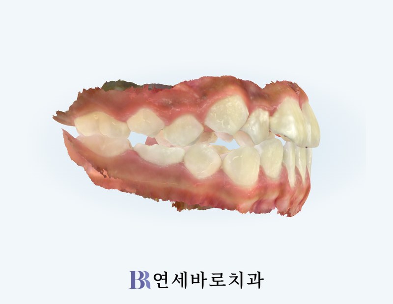 치료 전 우측