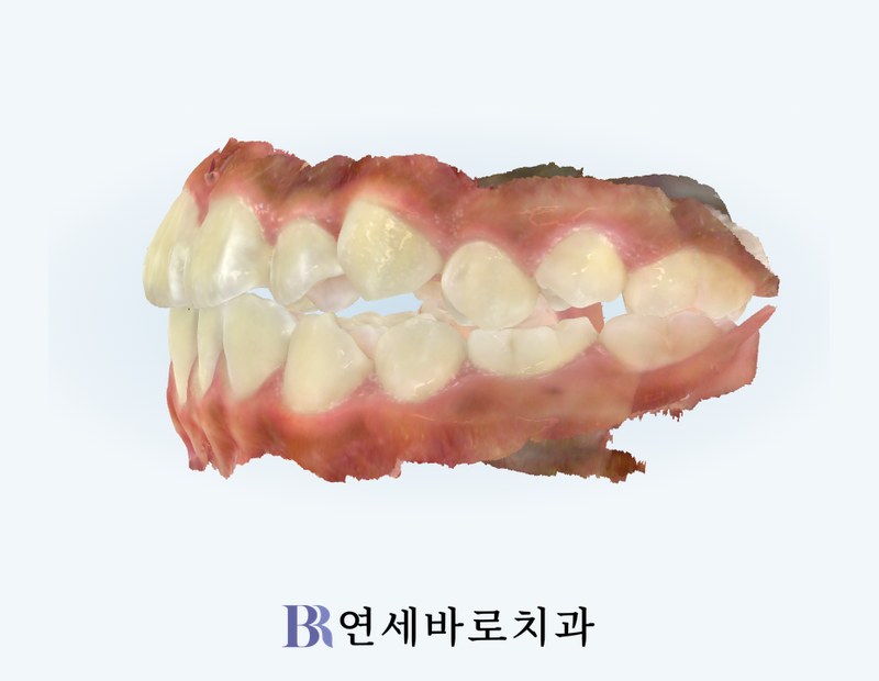 치료 전 좌측