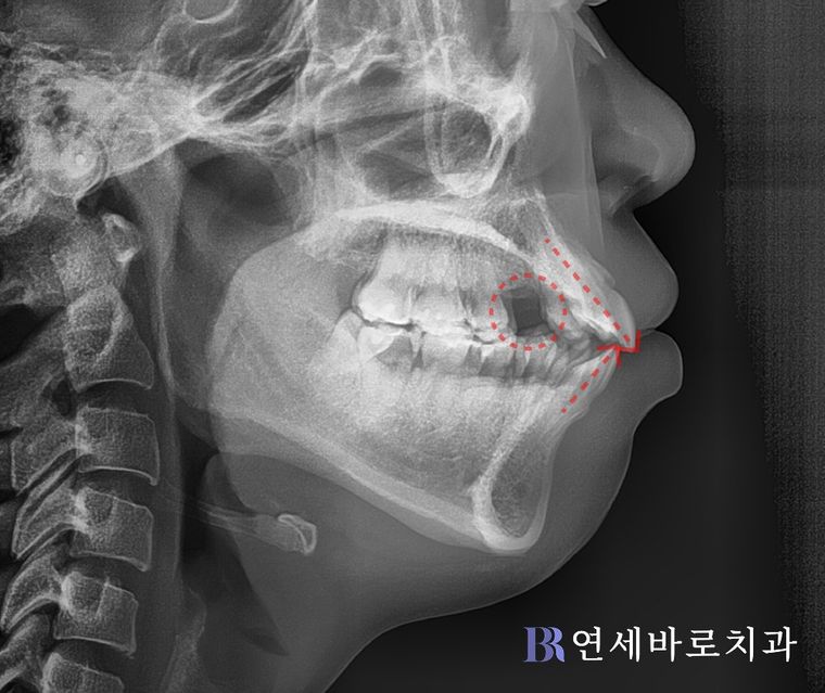 투명교정 발치교정 후 재교정 전 측면 두부 방사선 사진