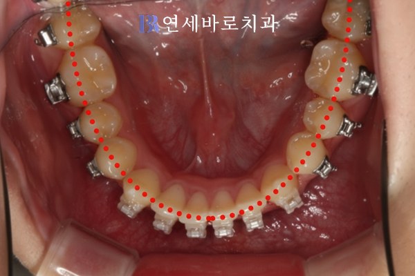 치료 중 하악 교합면