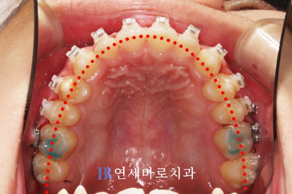치료 중 상악 교합면 세라믹 브라켓